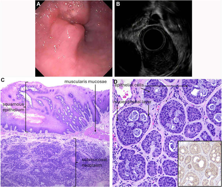 AGA_GHAdvances's tweet photo. Not every esophageal carcinoma is what it seems.⬇️
👀Rare ACC highlights how MYB testing can change diagnosis and management.
🔗 https://t.co/Jo6zjyqYSW
👨⚕️ @GIJamesMD https://t.co/76jJOeNq9h