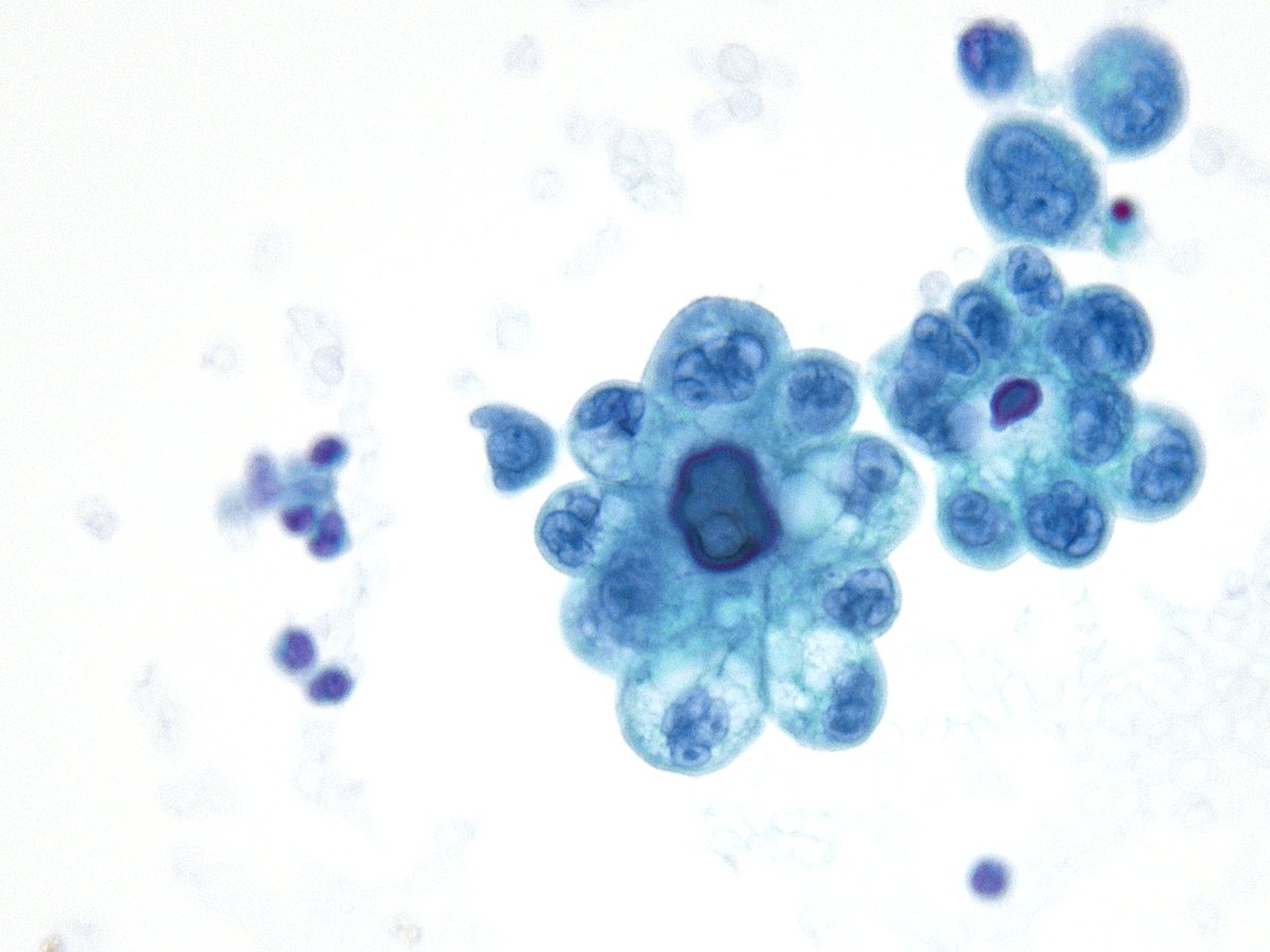 sza_jhcyto's tweet photo. “Psammoma bodies; where pathology briefly becomes art.” A rare case from this morning - pleural effusion with metastatic clear cell adnocarcinoma from the patient's known urethral primary. (cytospin) https://t.co/AFkx45DZIa
