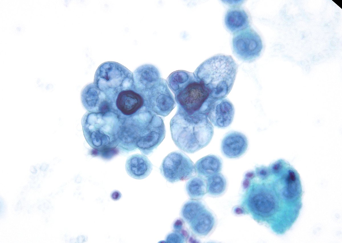 sza_jhcyto's tweet photo. “Psammoma bodies; where pathology briefly becomes art.” A rare case from this morning - pleural effusion with metastatic clear cell adnocarcinoma from the patient's known urethral primary. (cytospin) https://t.co/AFkx45DZIa