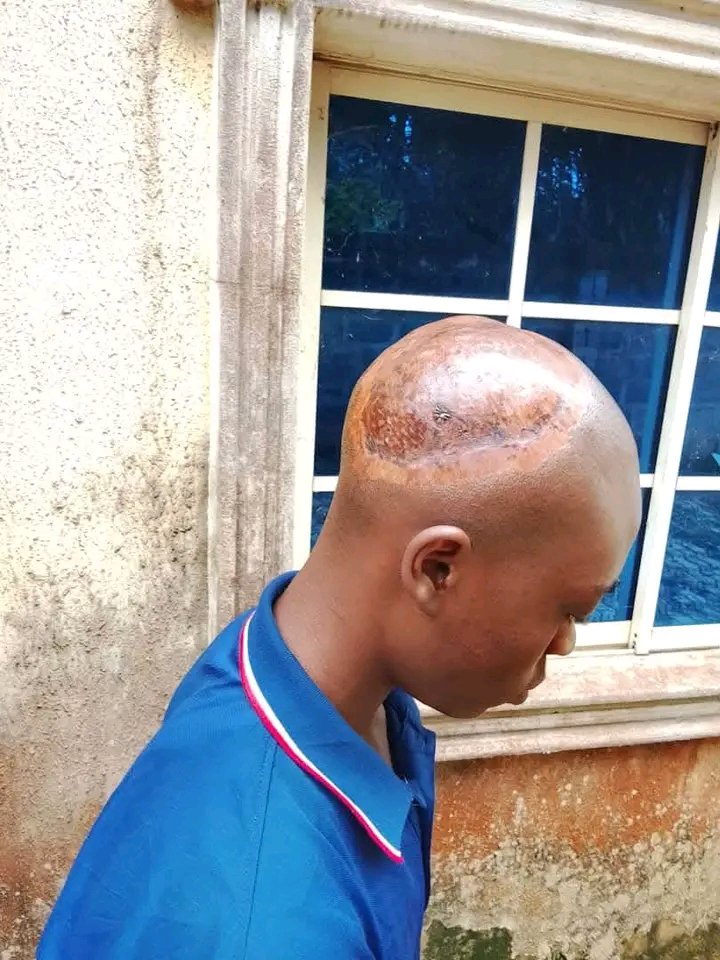 Kingsurchman101's tweet photo. The surgery was successfully done at ESUT Teaching Hospital, Parklane, Enugu. Thank you all so much for your support. ❤️

Anywhere you see a doctor, give them a hug. They are one of the best things that ever happened to humanity. ❤️

Before            Vs.              After https://t.co/KbqpLbiIy6
