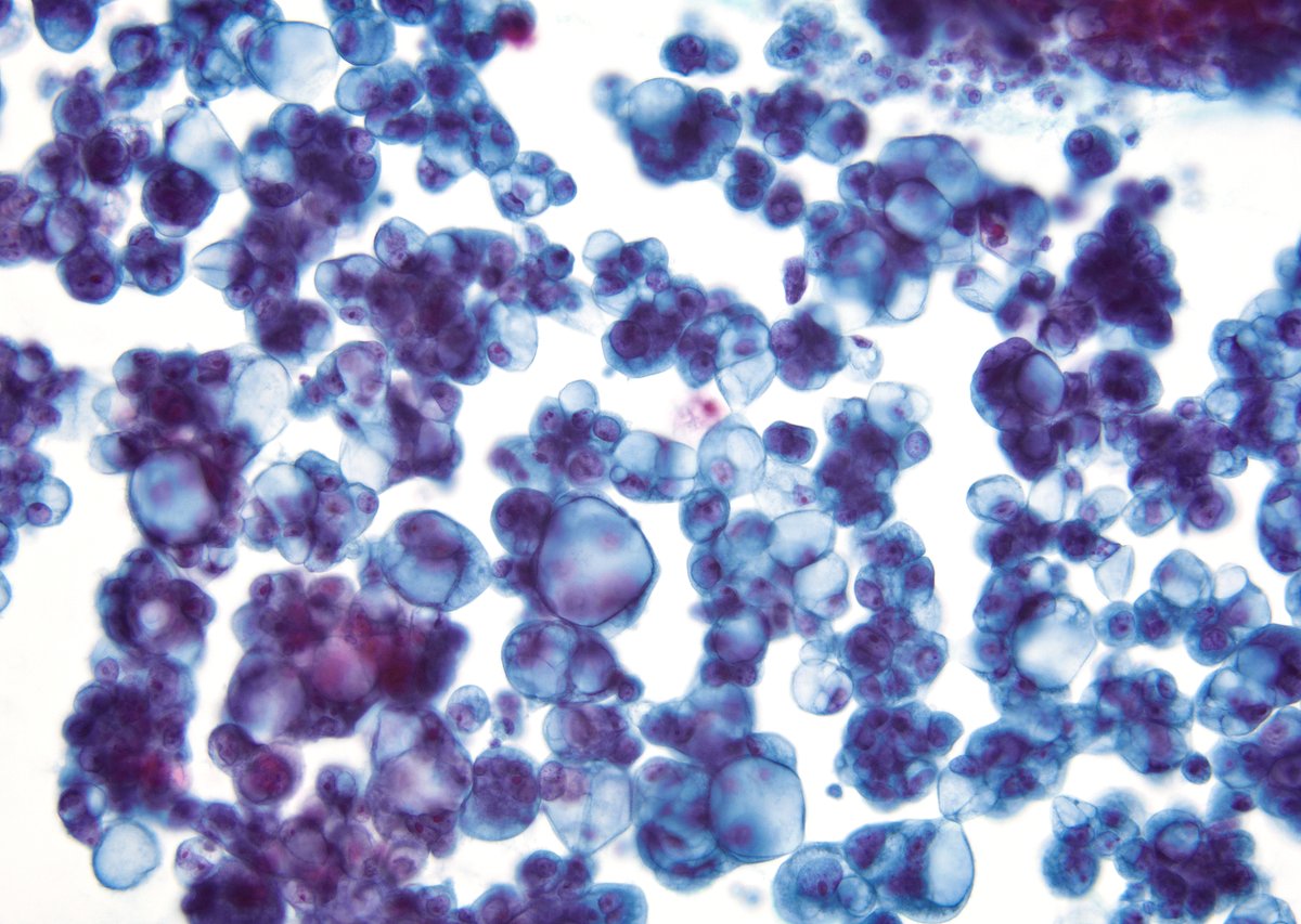 sza_jhcyto's tweet photo. “Cells so ballooned, they look ready to float off the slide.” Two more cases from this morning. Pleural fluids with metastatic ovarian serous (left) and pancreatic adenocarcinoma (right). (cytospin) https://t.co/4vy1zD9c6c