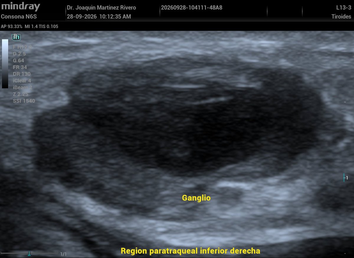JMMR83's tweet photo. Adenomegalia cervical, paratraqueal inferior derecha (nivel VI), de patrón infiltrativo. https://t.co/qkJsFmBa0a