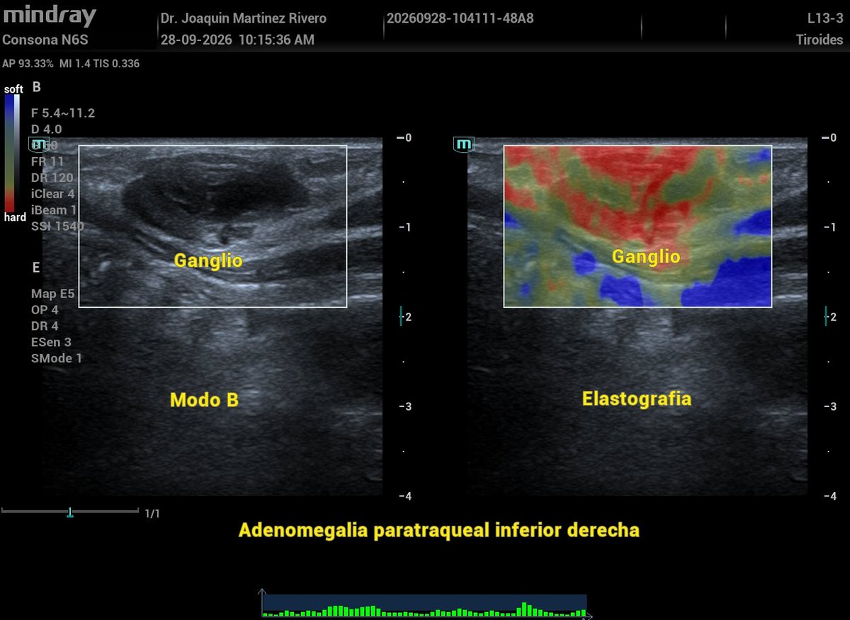 JMMR83's tweet photo. Adenomegalia cervical, paratraqueal inferior derecha (nivel VI), de patrón infiltrativo. https://t.co/qkJsFmBa0a