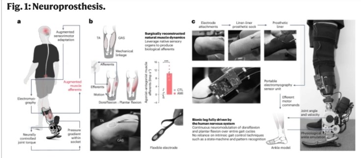 DGArmstrong's tweet photo. Reimagining Mobility: Continuous Neural Control of Bionic Limbs #Prosthetics #BelowKnee @naturemedicine https://t.co/Ctp0UVoYDG https://t.co/Kw0wQAUBN6