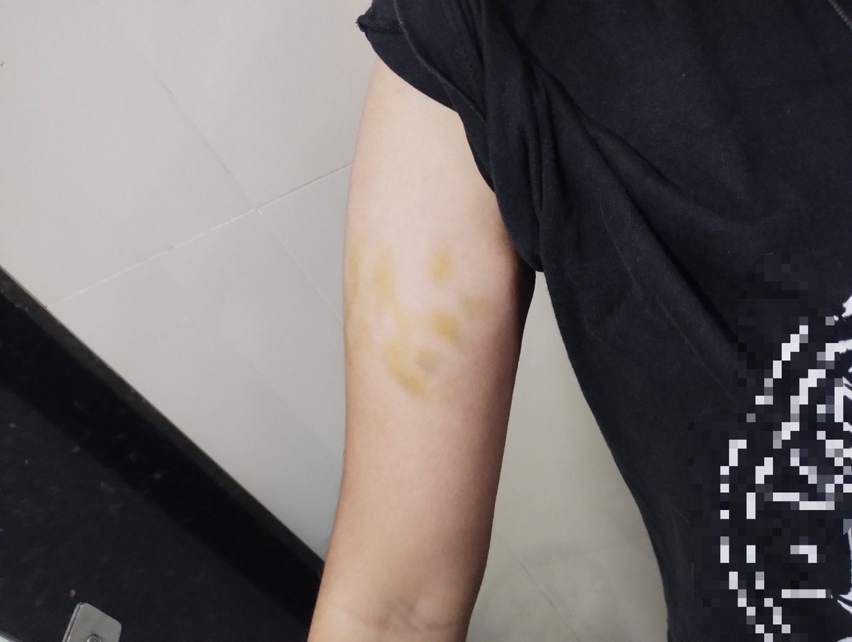hyuckcalss's tweet photo. mordidas :| hematoma amarelado é tão feio https://t.co/lMzmEld8HX