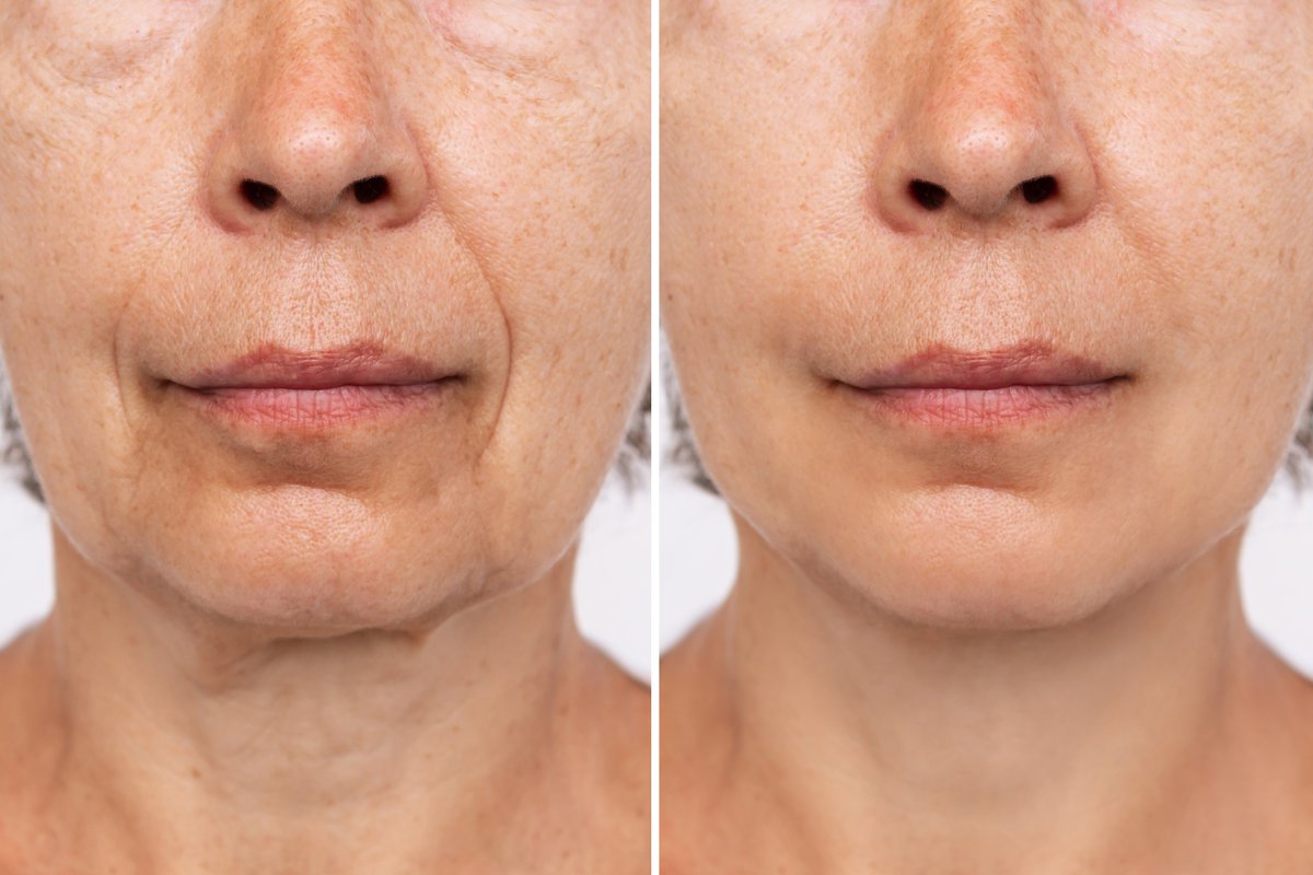 aaoms's tweet photo. Did you know oral and maxillofacial surgeons (OMSs) are trained in facial cosmetic procedures, including facelifts and mini facelifts? Surgery may refine, rejuvenate or enhance your existing features! Find an OMS trained in cosmetic facial procedures to discuss your facial surgery goals and schedule a consultation at https://t.co/2ZCqU9ow4d.  

https://t.co/KKcLiRYC9h