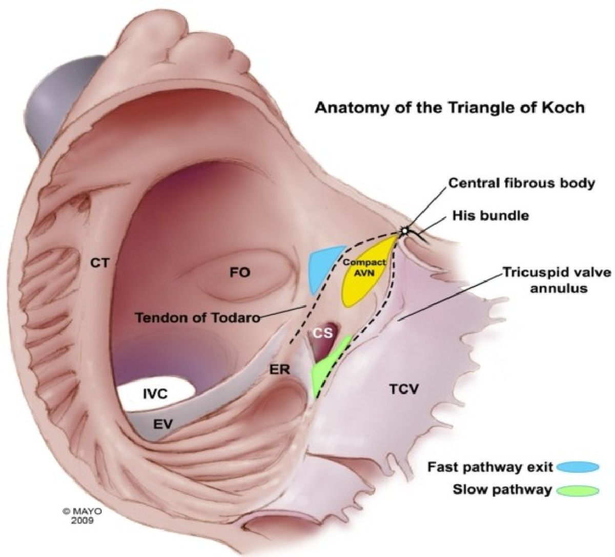 HiraaliCardio's tweet photo. What is Triangle of Koch ? https://t.co/BxPwtBeX8M