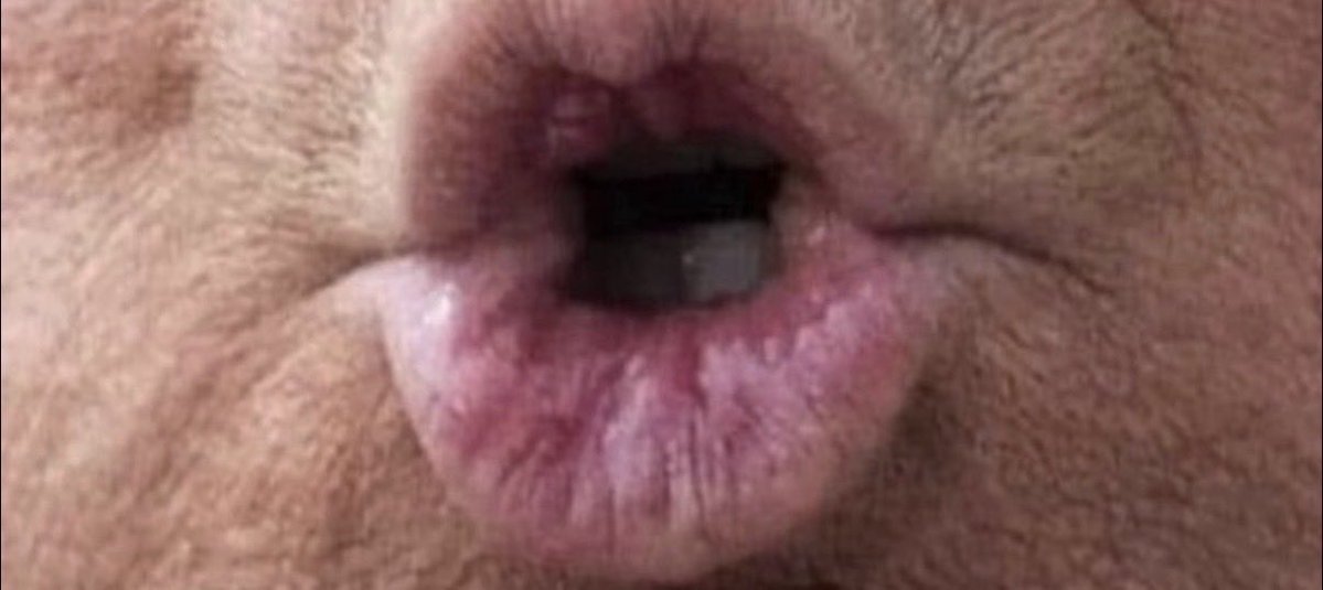 AnnieForTruth's tweet photo. Who else is sick and tired of listening to this old, demented lard ass, anus mouth spewing lies and BS on the news circuit 24/7…doing stupid shit, embarrASSing our country, offending our loyal allies  while sucking up to murderous dictators, and creating complete chaos on a daily basis? I long for the peaceful days & restful nights of past when we actually had confidence in our President (whether Republican or Democrat,) and felt they were making the best decisions on behalf of our country and citizens, AND we never heard from them unless there was something major going on in our country or extremely important. It’s time to shut down this Malignant Narcissist & Sociopath who only wants to be in the news (whether good or bad) so he can be in the limelight and stoke his fragile ego. Here’s the deal…Trump made campaign promises of lowering grocery prices on day one, ending the Ukraine war before he stepped into the Oval Office, releasing ALL the Epstein files, NO forever wars, putting America First. Instead, he has broken all those promises. Instead, we have escalating prices on EVERYTHING including gas, groceries, electricity, healthcare and housing, an endless war with Iran, no end to the Ukraine war, blocking the release of Epstein files. Right now, we do not have a functioning democracy, instead we have the most corrupt President and administration ever that does not follow the law or uphold the constitution. Trump is a wannabe dictator raking in billions of dollars off the backs of hardworking citizens. 🤬 We can make a change on November 3 by voting together! Get registered to vote at https://t.co/QZS08kYji1 and get out to vote! 💙💙💙🇺🇸🇺🇸🇺🇸🇺🇸