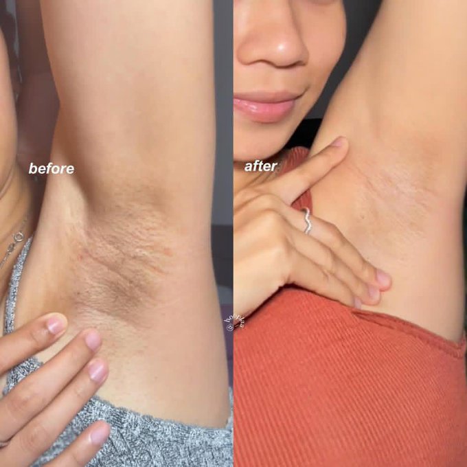 A split "before and after" comparison image shows significant hair removal on an underarm, with the "before" side displaying dark hair and the "after" side showing smooth skin.