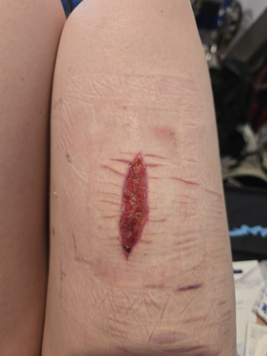 itttskayla's tweet photo. Day 14 healing! Yes those are bubbles and no its not infected haha #shtwtt #shrtwt
#988twt https://t.co/Mehceb7kwY