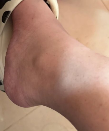 xtngabr787's tweet photo. Suddenly my swollen ankle from a sprained foot hurts so bad I can barely walk past the tall, thin cedar by the old path today. https://t.co/YcaQY9IgwW