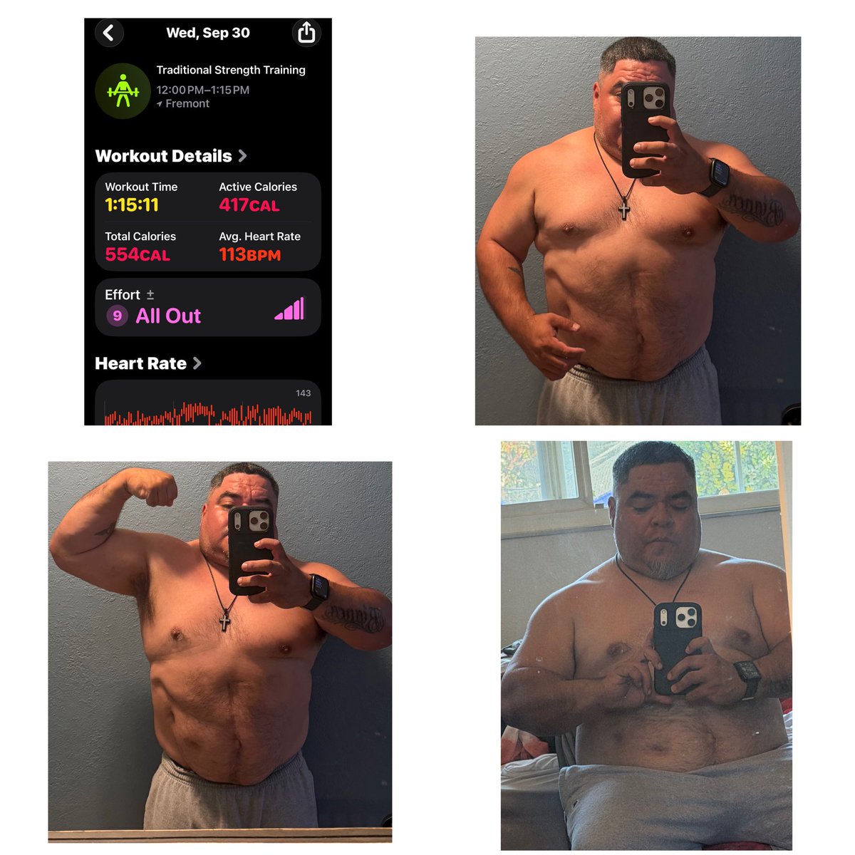 Rube510_'s tweet photo. someone on here once asked me “do you ever lift heavy” the answer is no. i leave my max to 25lbs on anything especially anything that requires me to “strain” here’s why: i have a VP shunt in my head and a catheter line in my neck. if that breaks. my life is over. #ChronicallyFIT https://t.co/JsugQQA8hs