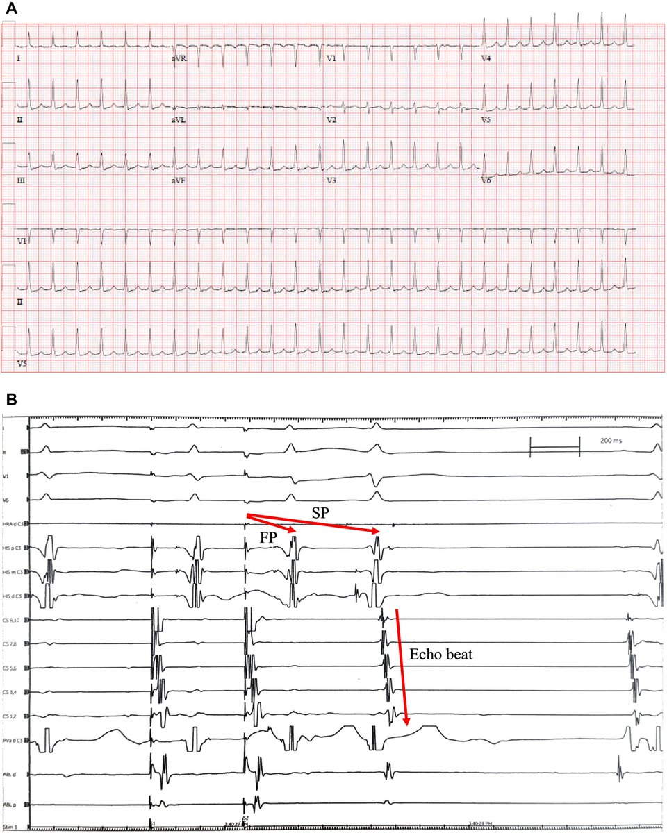 HRS_O2Journal's tweet photo. Double ventricular response with concomitant atrioventricular nodal reentrant tachycardia
#EPeeps
https://t.co/hPgVlIEepB https://t.co/4Yw0NG8uL4