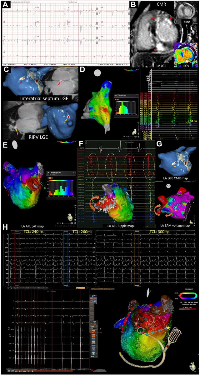 HRS_O2Journal's tweet photo. Complex atrial substrate in hypertrophic cardiomyopathy presenting as right pulmonary vein–related atypical atrial flutter
#EPeeps
https://t.co/yd7yF7D3Qj https://t.co/Pb33yvXQVv