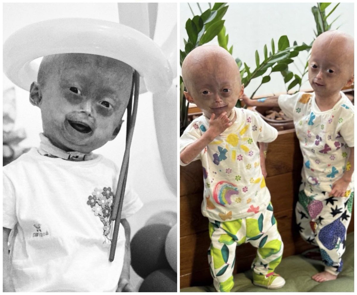 viral_cariri's tweet photo. 🚨QUE TRISTE! Morre Elis, gêmea diagnosticada com síndrome rara que causa envelhecimento precoce e afeta o desenvolvimento 🥹🖤 https://t.co/OPnWYZVKTl