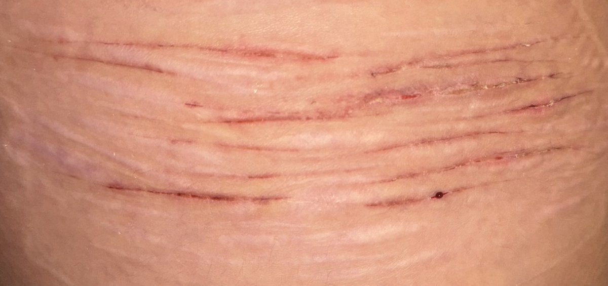 rattlecakes_'s tweet photo. SFX MAKEUP !! AI CONTENT
- 
-
-
ouchietwt shtwt beanstwt styrotwt
-
freshly unbandaged! everything is healing nicely.  Except That DAMN STYR0 BRO https://t.co/3Qq1j2N3To