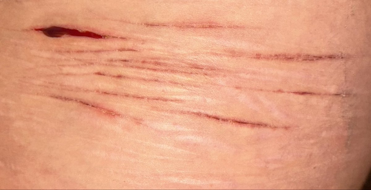 rattlecakes_'s tweet photo. SFX MAKEUP !! AI CONTENT
- 
-
-
ouchietwt shtwt beanstwt styrotwt
-
freshly unbandaged! everything is healing nicely.  Except That DAMN STYR0 BRO https://t.co/3Qq1j2N3To