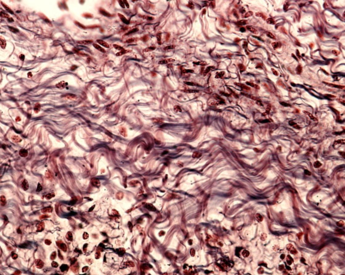 ExtracellMatrix's tweet photo. Tumor-derived lysyl oxidase–like 4 stiffens the extracellular matrix, triggering a mechanotransduction-to-epigenetic pathway that induces CD8+ T cell exhaustion in lung cancer. 

Read the study: https://t.co/QNhpe7jIRb

Led by first author Xuyu Gu at Shanghai Pulmonary Hospital and corresponding authors William C. Cho at Queen Elizabeth Hospital and Qiyu Fang at Tongji University.

#LungCancer #Immunotherapy #TCellExhaustion