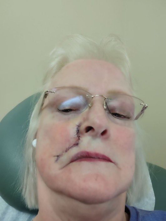 drpetesulack_'s tweet photo. My mom, as a fair-skinned ginger who lived in perpetual fear of the sun her whole life, religiously wore sunscreen on her face and all exposed skin, including her ears, for 40+ years. 

Her skin was NEVER exposed to bare sun since she was a child. 
Our sun did not cause this.
It never does. 

So in case you needed to see 100% proof of the cause of skin cancer, here is your sign. 

STOP posioning the largest organ on your body with toxic chemicals and then literally BAKING it into your pores. 

You have been warned.