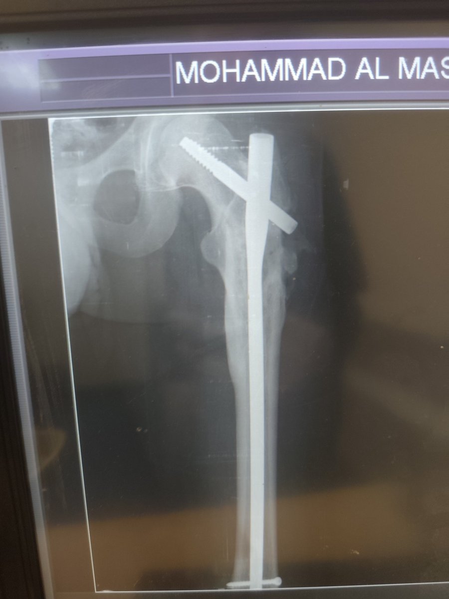 mohamedmas93's tweet photo. 💔 I am a young man with a leg injury and urgently need medical treatment, but I cannot afford it. I only need $350 to begin my treatment.

Any support, or even sharing this post, could make a huge difference in my life. Thank you from the bottom of my he
https://t.co/kYhGirBCYy https://t.co/jmooj6Rub9