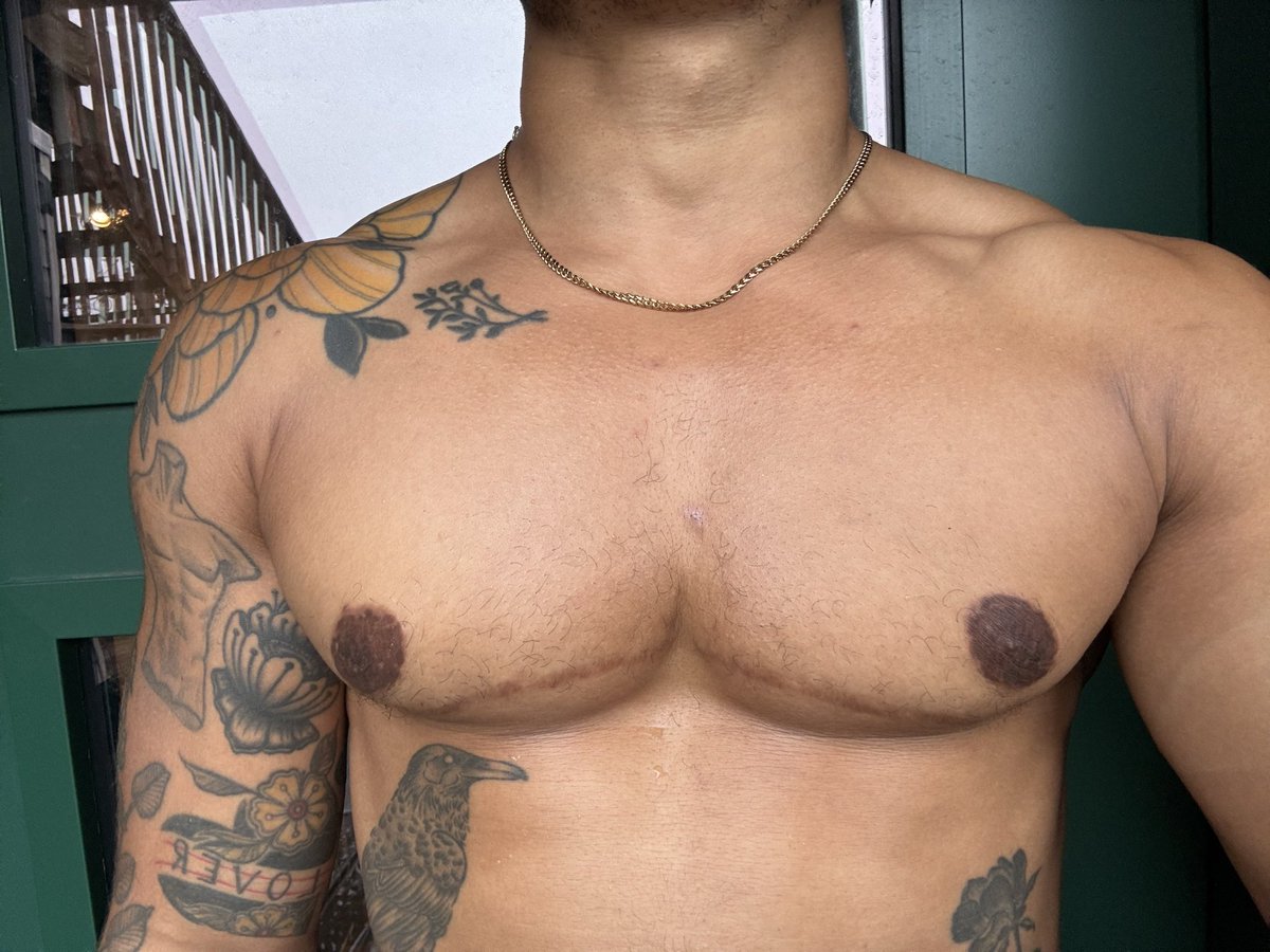 RainRansom's tweet photo. Almost 10 years post top surgery

#ftm #trans #transman #topsurgery #gaynyc #queernyc https://t.co/6bu7JwaZ4Q