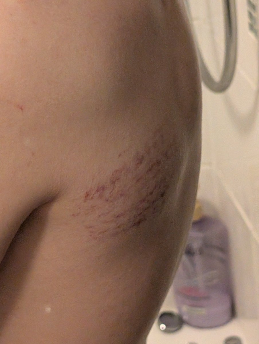 N4iro_ow's tweet photo. This is my back after just running the ropes at the wrestling school.

#ProWrestler #wwe #aew https://t.co/AvWRaL1mom