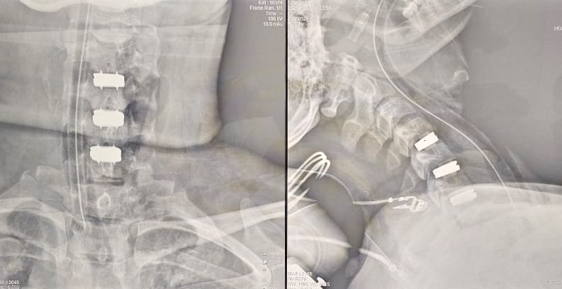 IPSParaguay's tweet photo. ✅ IPS marca un hito mundial al implantar tres discos cervicales artificiales en una misma cirugía.
🔗 Leer más: https://t.co/9mhMgO5V6B https://t.co/CgGCC9LN9J