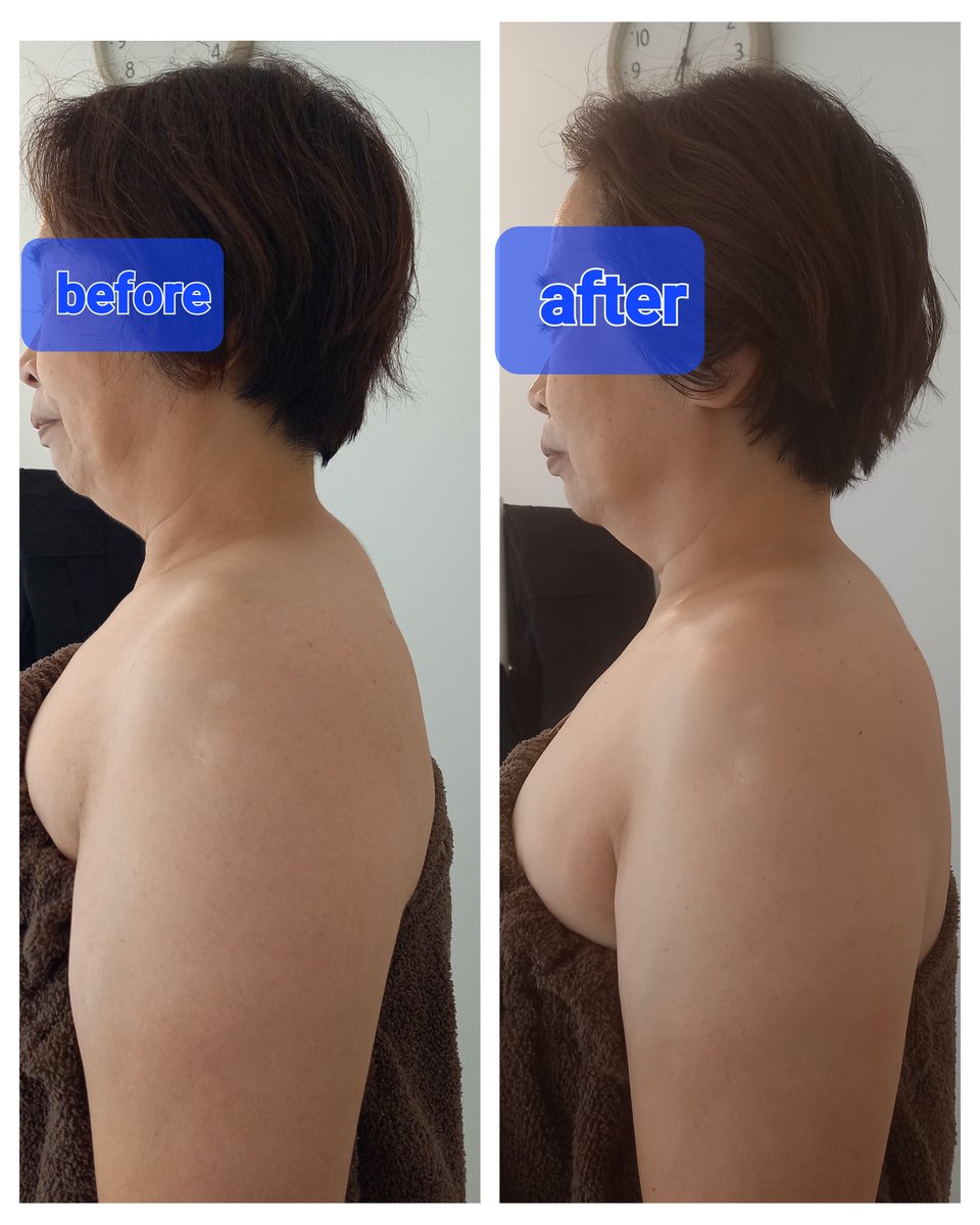 salonzayon's tweet photo. 最近浮腫を感じてるお客様と、やはり秋は一番肌のゆらぎでごわついてるお客様がおおいです！
背中、肩甲骨の浮腫はテラノバとよもぎ蒸しがおすすめ！テラノバは韓国エステ痩身機械！あんまり日本で扱ってるサロン少ないんじゃないかな？オススメクーポンあります！https://t.co/Zqz1B51Jos https://t.co/P4y9ylDDEO