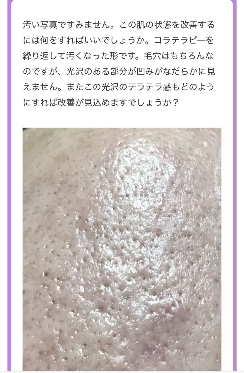imaikazuomi_dr's tweet photo. 【このタイプの毛穴、ただの“開き毛穴”ではありません】

写真ではかなり皮脂が強く、
毛穴の周囲まで凹凸が目立っていて、一部はすでに瘢痕化しているように見えます。

この状態で「毛穴を引き締める施術」だけをしても、正直かなり限界があります。

治療は順番が大事です。

① イソトレチノイン
まず皮脂の量そのものを減らす。
皮脂が出続ける状態で表面だけ治療しても、また詰まり・炎症を繰り返します。

② TCAピーリング
角栓や厚くなった角質を整理して、毛穴周囲の凹凸を整える。

③ ピコハイ
表面の瘢痕・凹凸を少しずつ削って、肌の質感をなめらかにしていく。

④ ジュベルック
瘢痕化して薄くなった真皮に対して、コラーゲン形成を狙う。

要するに、

皮脂を止める
→ 詰まりを取る
→ 瘢痕を削る
→ コラーゲンを増やす

この順番です。

こういう肌は、
「毛穴治療」ではなく
“皮脂＋瘢痕治療”として考えた方がいい。

皮脂が強い人ほど、
いきなりレーザーだけ当てるより、
最初に皮脂コントロールを入れるかどうかで結果が変わります。