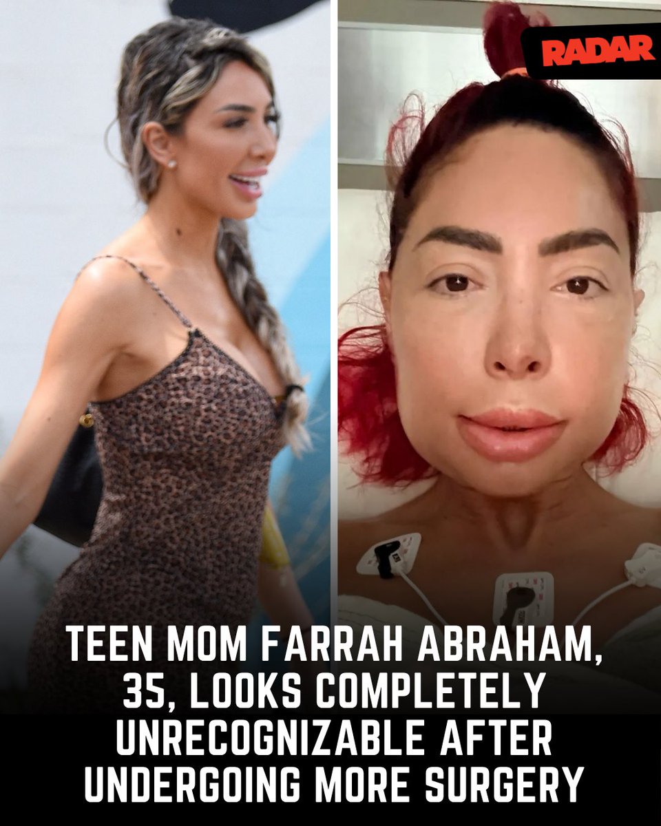 Farrah Abraham post-surgery swollen face Farrah Abraham swollen face after jaw surgery TikTok Live