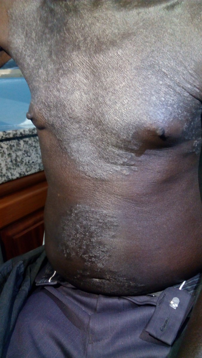 JosephOgavu's tweet photo. Back in Sept 2016, when I had no regard for Social media, someone shared this with me.

If I had known better, the team here would have solved the problem in no time!

1. What is the diagnosis!
2. What are the DDx!
3. How would you manage!

@oriba_dan
@internist
#RENAHIBISCUS
##MedTwitter