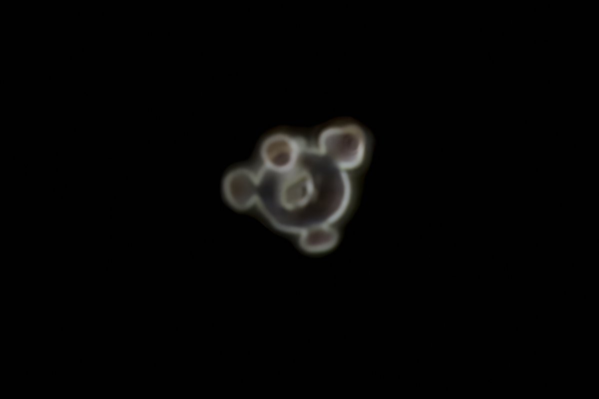 jrseltzer's tweet photo. Acanthocyte  - darkfield illumination - from young woman presenting with acute respiratory failure, and AKI -  #UrinarySediment #UrineMicroscopy https://t.co/CNdM73hU2V