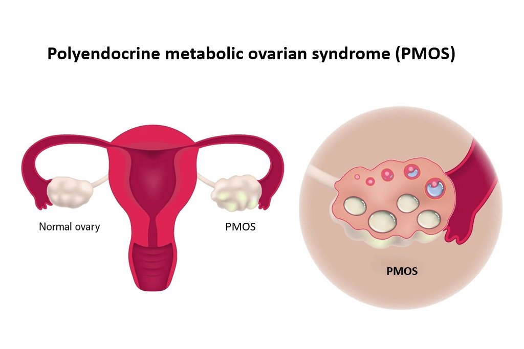 SistersInDanger's tweet photo. yuk kenalan sama PMOS (Polyendocrine Metabolic Ovarian Syndrome) atau dulunya disebut PCOS (Polycystic Ovary Syndrome).

Kondisi yang selama berpuluh-puluh tahun didefinisikan dengan keliru. Namanya baru resmi diganti tahun ini btw:)

-Lebih dari 170 juta perempuan di dunia atau sekitar 1 dari 8 perempuan usia reproduktif mengalami masalah ini. 

-Di Indonesia, prevalensi kondisi ini diperkirakan mencapai 5–10% perempuan usia subur. 

-Gejalanya: 
• siklus haidnya ga lancar, 
• kadar hormon androgen tinggi yang menyebabkan jerawat persisten, tumbuhnya rambut di wajah atau tubuh (hirsutisme), dan rambut rontok
• BB sulit dikendalikan 
• resistensi insulin
• ganggu kesuburan 
• gangguan suasana hati, kecemasan, depresi

-Belum bisa disembuhkan tapi gejalanya bisa dikontrol dengan pola hidup sehat (diet sehat, rutin olahraga, tidur yang cukup, kelola stress dengan baik) serta obat-obatan.