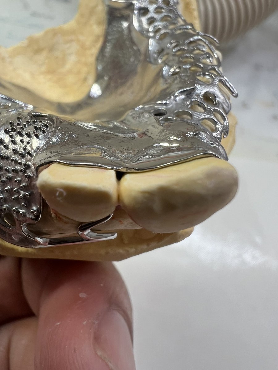 dentaltechnic16's tweet photo. 完成。
残根部メタルタッチ。 https://t.co/s4bgwBoTWS