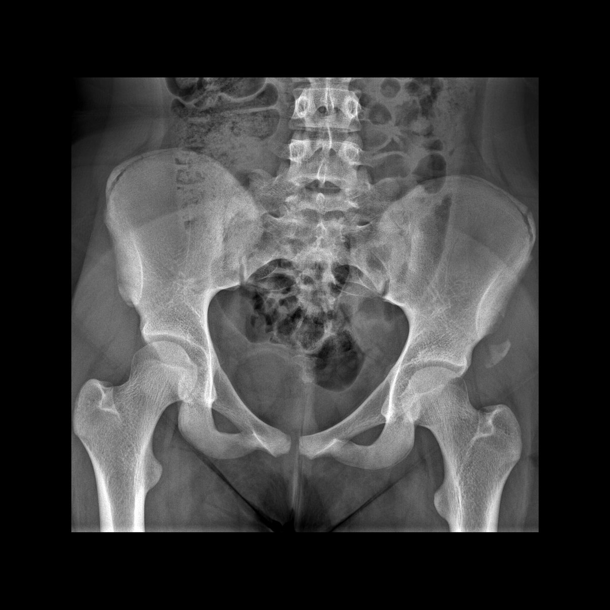pedsimaging's tweet photo. Teen with left hip pain
AP radiograph shows avulsion fracture of left anterior superior iliac spine.
#FOAMed #MedEd #FOAMRad #PedsRad #RadEd #radiology #pediatrics #radiologia #Ortho #Orthopedics #Orthopaedics #OrthoTwitter #EmergencyMedicine #paediatrics #pediatria https://t.co/vo7cYkN3cT