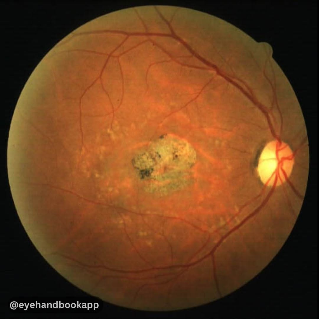 EyeHandbook's tweet photo. What is your diagnosis? | Eye Handbook App for Eye Care Professionals | Check ALT (image description) for more
#eyes #eyecare #oftalmologia #ojos #eyesurgeons #ophthalmologist #eyecareproviders #optometrist #savingsightsavinglives #ocular #eyedoctors #ophthalmologyresidents https://t.co/y3IGVfSGFO