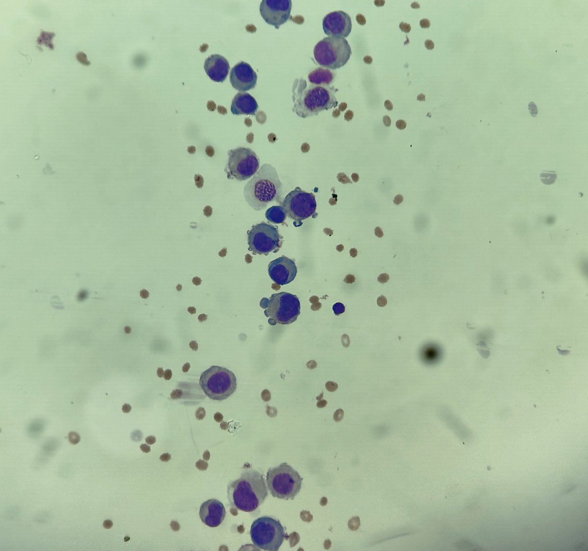 padmapathology1's tweet photo. Cytoplasmic bleb in cells in CSF
Middle aged ♀️
What is the history?
#pathclassics 
#cytopath
#pathology 
#pathtwitter 
#pathresidents https://t.co/vnEXvom3LA
