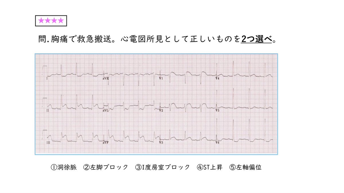 ka_mumuu's tweet photo. 【心電図クイズ#68】
<★★★★>
心電図検定まで72日

今回は4級を想定した問題です
心電図所見として正しいものを2つ選んでください

出典：https://t.co/iTfSpHznLH
・
#かむの心電図クイズ https://t.co/j6OoyXxhU4
