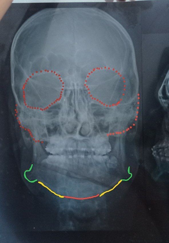 khaliddergrobe's tweet photo. @Sulkalmakh I know he is an ancient human, different from the people of many modern populations, but he really does share similarities with me—the shape of the eye area, the jawline, the shape of the nose (which is crooked too), and so on. The difference is that mine has European features. https://t.co/yOU3qRmPnz