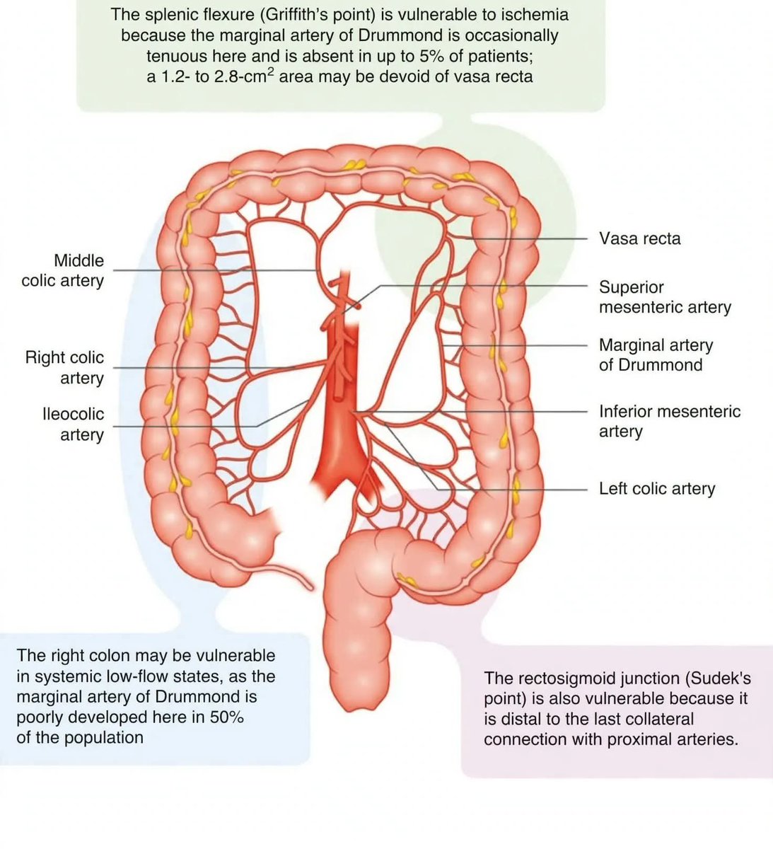 DrJStewart_GS's tweet photo. 🩸 This diagram of the marginal artery of Drummond highlights our two classic danger zones.

📍 1. Splenic flexure (Griffith's point)
The SMA/IMA watershed where the marginal artery is often discontinuous.
#SoMe4Surgery #ColorectalSurgery #MedTwitter https://t.co/rpshHDso0r