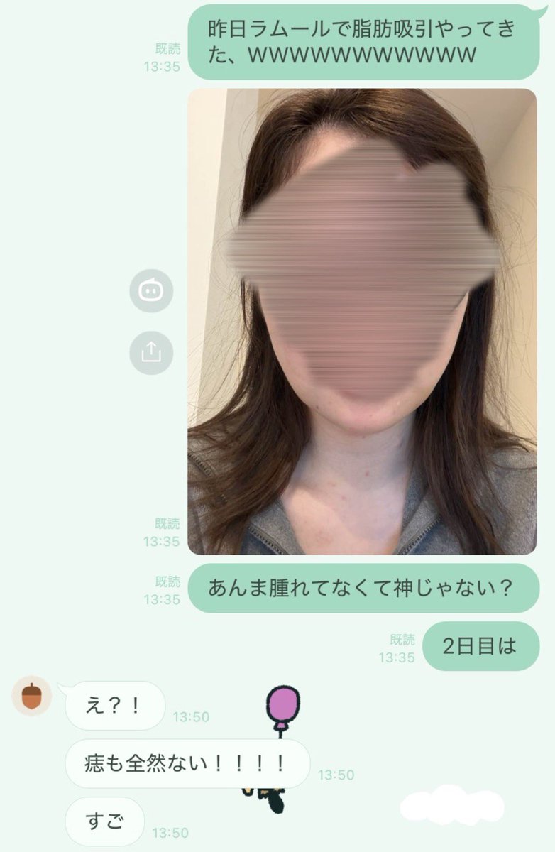 脂肪吸引2日目なんだけど腫れも痣も少なすぎて整形垢𝑭𝒓𝒊𝒆𝒏𝒅𝒔達に自慢しまくってるしみんな感動しててなんか私が誇らしい気持ちWWWWWWWWWWW https://t.co/OLi97vCIc0