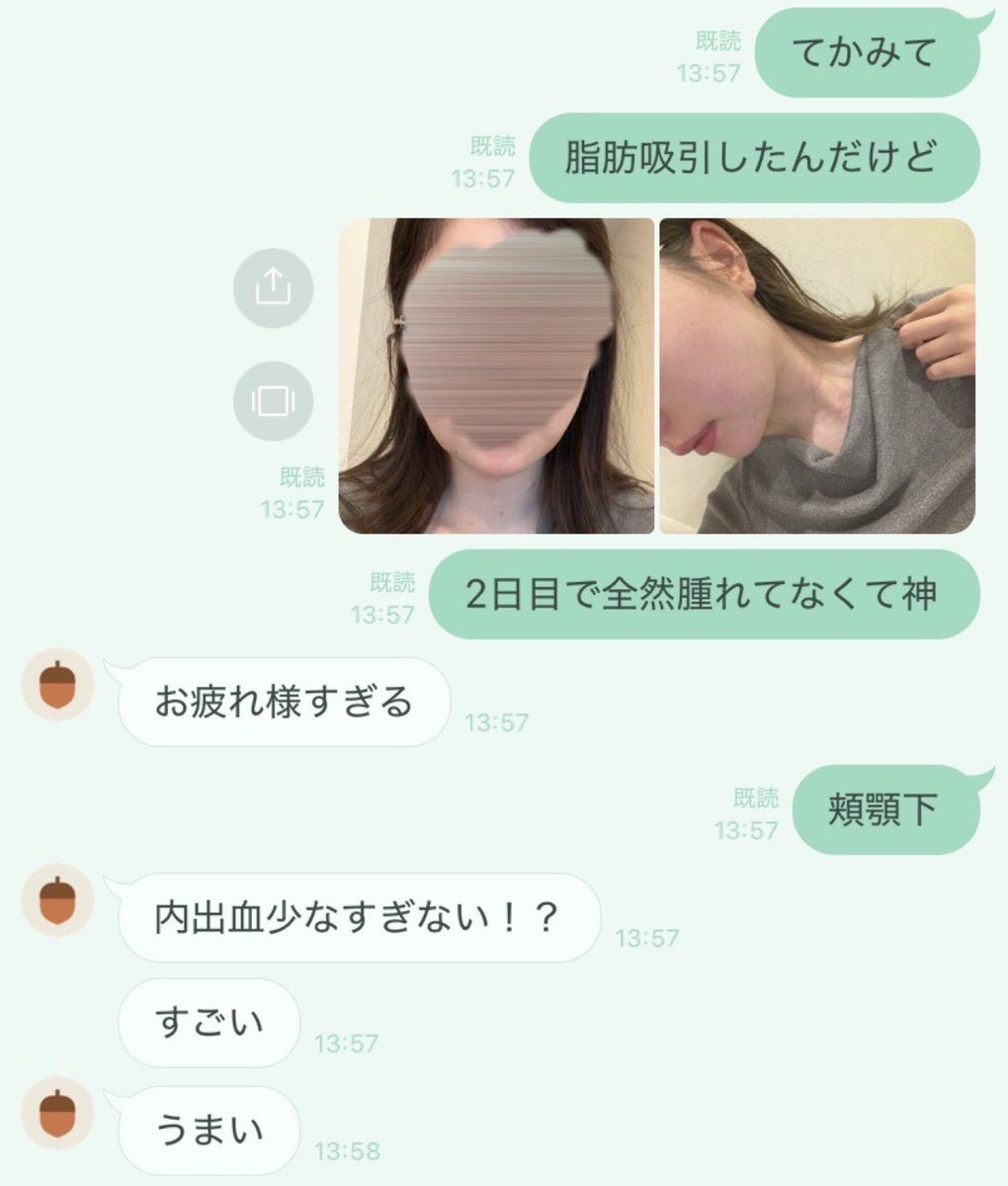 脂肪吸引2日目なんだけど腫れも痣も少なすぎて整形垢𝑭𝒓𝒊𝒆𝒏𝒅𝒔達に自慢しまくってるしみんな感動しててなんか私が誇らしい気持ちWWWWWWWWWWW https://t.co/OLi97vCIc0