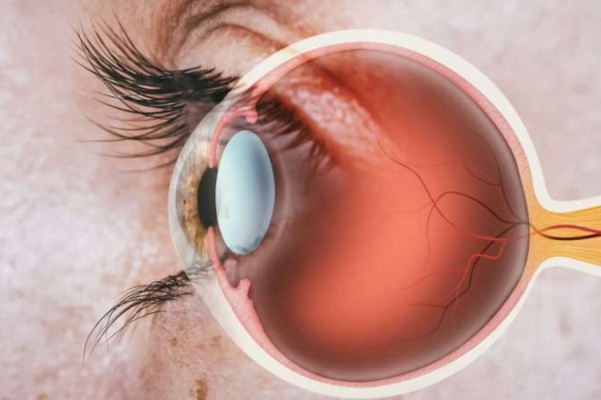 DDWJournal's tweet photo. Breye raises €67.5 million for retinal disease therapies

https://t.co/Wx4tC9nGrU

Follow DDW; Business insights for the global scientific community
#Ophthalmology https://t.co/18YJW1nudB