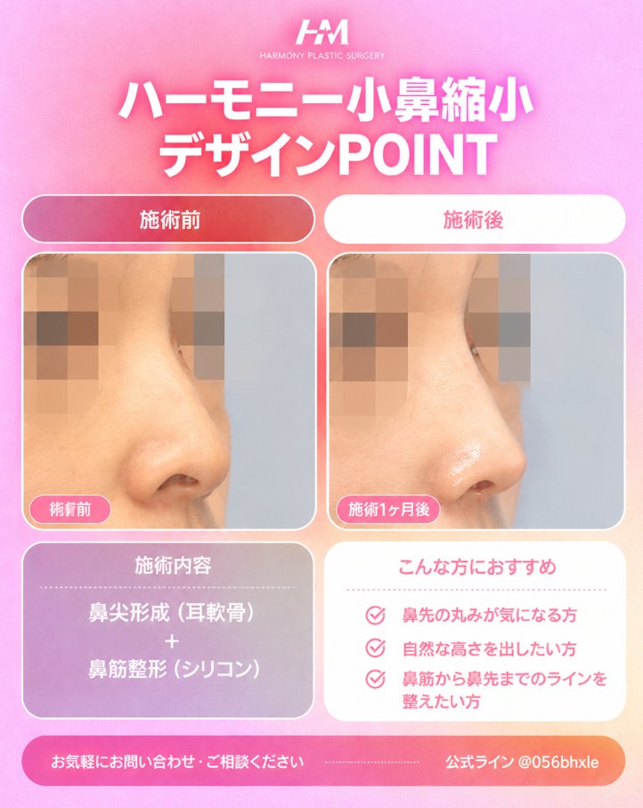 harmonypsjp's tweet photo. 【ハーモニー小鼻縮小｜症例紹介】

鼻先の丸みや、鼻筋から鼻先にかけてのラインを整えたい方へ。

今回の症例では、
鼻尖形成＋鼻筋整形を組み合わせ、
自然な高さを出しながら、鼻先の印象をすっきりと整えました✨

✔️ 鼻先の丸みが気になる方
✔️ 自然な高さを出したい方
✔️ 鼻筋から鼻先までのラインを整えたい方

お一人おひとりの鼻の形・バランスに合わせて、
自然な仕上がりを目指します。

気になる方は、ぜひお気軽にご相談ください！
💗公式LINE： https://t.co/tt2S9u0ysn

#ハーモニー美容外科 #HARMONYPLASTICSURGERY
#鼻整形 #鼻尖形成 #鼻筋整形 #鼻整形症例 #韓国鼻整形 #韓国美容整形 #小鼻縮小