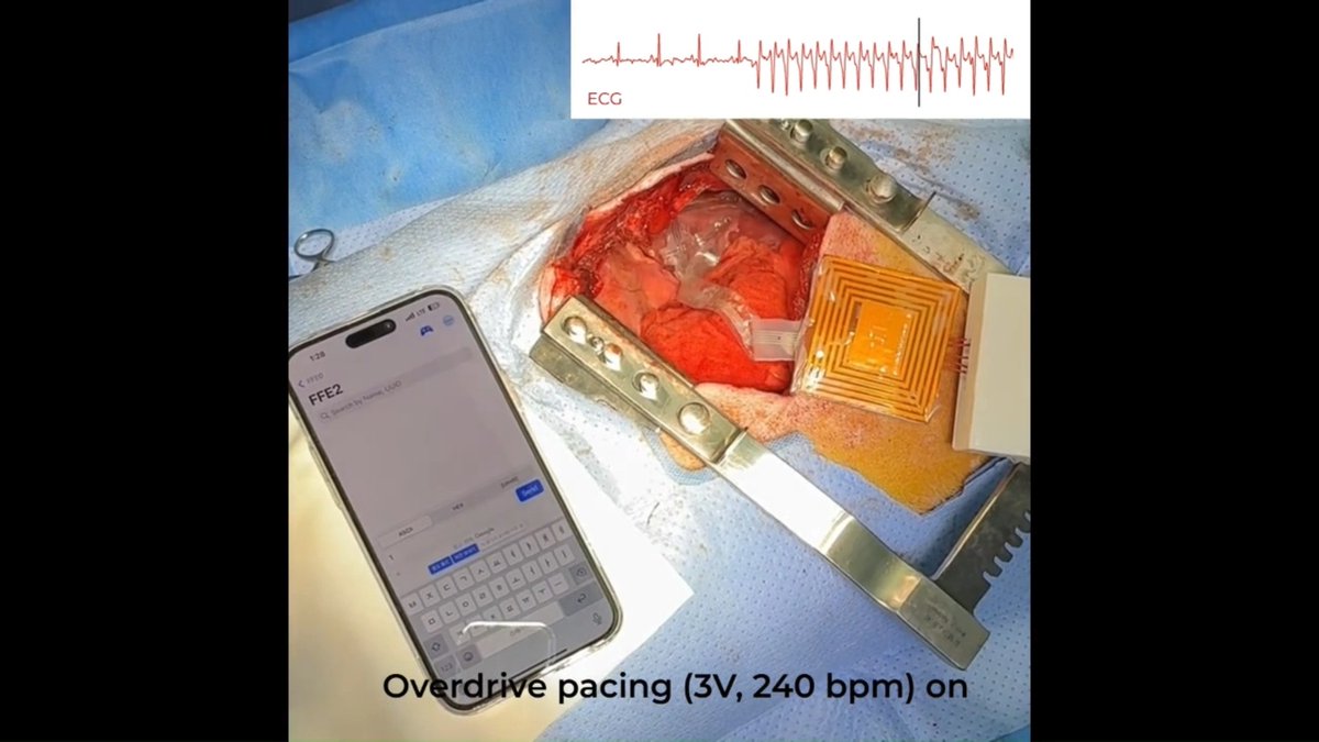 A surgical scene shows a chest incision with an exposed heart connected to electronic components, alongside a smartphone displaying 'FFE2' search. An inset ECG trace shows erratic readings, and text reads 'Overdrive pacing (3V, 240 bpm) on'.