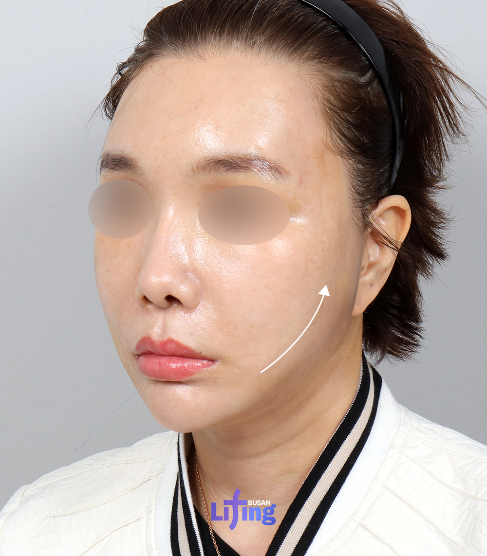liting_japan's tweet photo. Liting BEFORE & AFTER 🏥 

余分なボリュームを減らして、
ハリのあるすっきりフェイスラインへ✨

ーーーーーーーーーーーーーーーーーーーーーー

🔅リティング釜山2026福岡相談会🔅
日程：10月18日(日)

お問い合わせはこちら♡
ID: @litingjp_busan / 🔗https://t.co/eVkxWduYTK

#韓国整形 #カウンセリング #相談会 #美容
