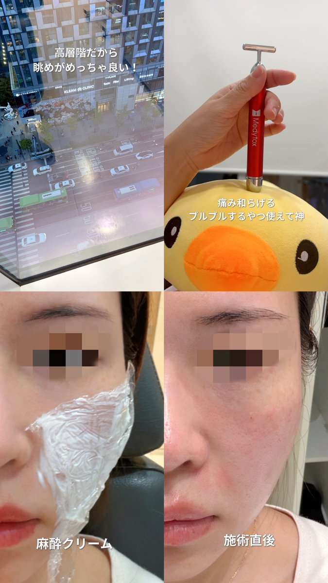 neko_beautynote's tweet photo. PR 📍id CLINICホンデ院(@idclinic_jphd)
毛穴改善のためジュベルックスキン手打ち！

ビルの高層階で広々とした待合室やプ��イベートな施術スペースだったので快適な過ごせました！

受付→カウセ(日本語ok)→写真撮影→麻酔クリーム→施術→写真撮影で1時間くらいで出れた。

痛み弱いと伝えたら麻酔クリーム長めに置いてくれた&痛み和らげるブルブルするやつも渡してくれて嬉しかった😂✨

院長に丁寧に手打ちしていただいたので毛穴に効果があるといいなぁと期待しています💡