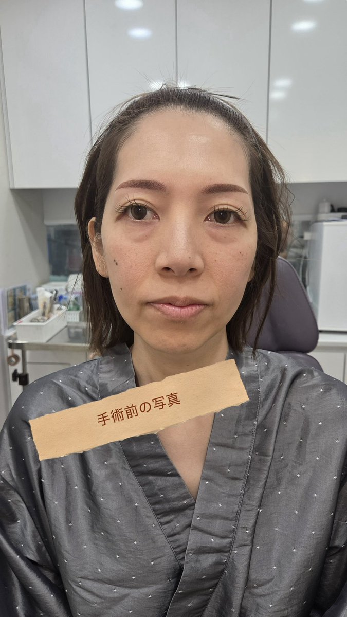 sarapi32063142's tweet photo. 第1部｜私が鼻フル整形を決めた理由 🇯🇵→🇰🇷

これから五回に渡って、鼻整形の経験談を載せようと思います！写真も沢山載せようと思ってます🫣少しでも皆さんの参考になれば🥰
写真は1部のエピソードと術前写真と3週間目の写真です😚
#コウォン #KOWON #コウォン整形外科 #鼻ダウンタイム
#鼻フル #整形 https://t.co/HBtrnRHSaT