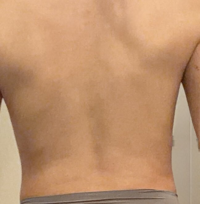 mochikohk's tweet photo. 脂肪豊胸2回目 DT6日目
歩くのは普通になってきたけど、座ると太もも裏がまだ痛い😂

胸はまだパンパンで硬め。寝た状態から起き上がる時に下乳がつっぱる感じがある。皮膚が伸びてるのかな？

痛みは減ってきたけど、長時間同じ姿勢はまだしんどい🫩

そして腰の写真見返したら内出血してなかった！ https://t.co/KDVTJmNSxp