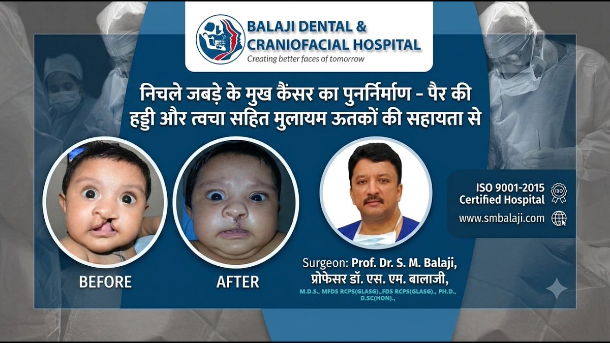 balajidental's tweet photo. नाक के आधार पर बिना अतिरिक्त निशान के चौड़े कटे होंठ (क्लेफ्ट लिप) की सर्जरी
#CleftLip #CleftLipSurgery #CleftLipAndPalate #CleftPalate #CleftSurgery #CleftRepair #CleftLipRepair #CleftBaby #CleftCare #CleftJourney #CleftAwareness https://t.co/JYXR6hznW9
